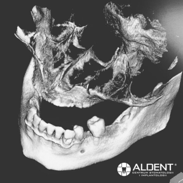 tomografia komputerowa 3D CBCT Lublin, CSK ALDENT