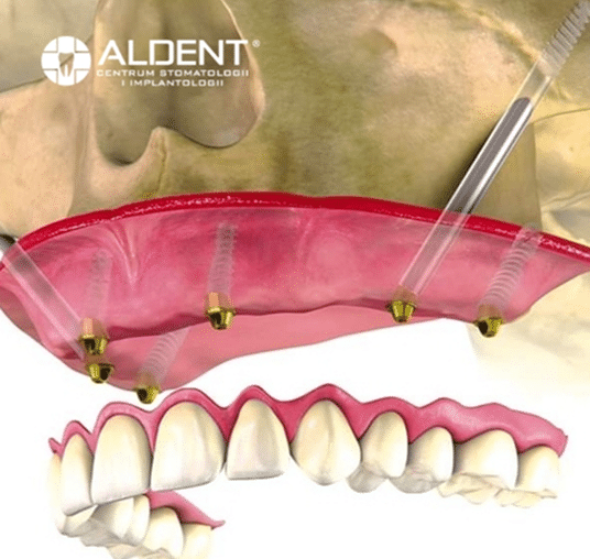 Technologia i stabilność implantów zygomatycznych