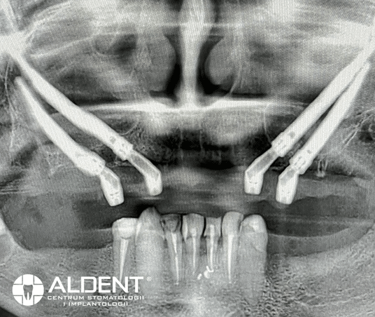 zastosowania implantów zygomatycznych