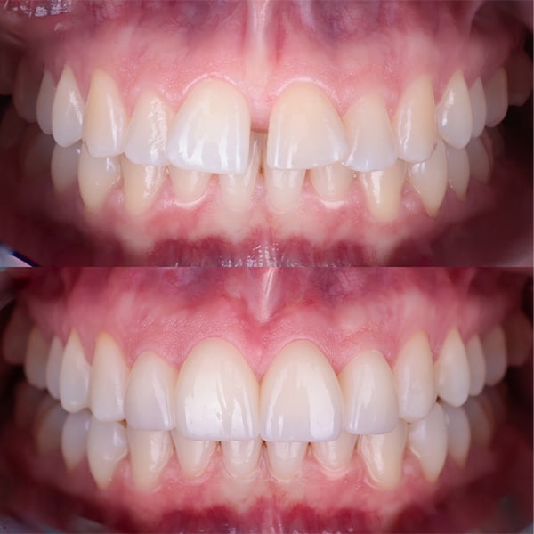 Frenuloplastyka dzieci i dorosłych