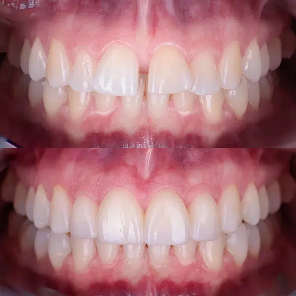 Frenuloplastyka dzieci i dorosłych podcinanie wędzidełka Lublin