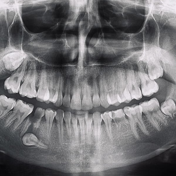 Odsłonięcie zębów zatrzymanych
