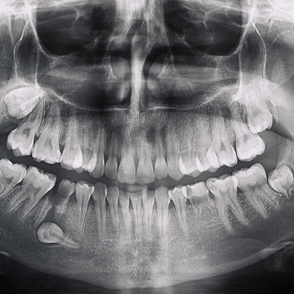Odsłonięcie zębów zatrzymanych LUBLIN ALDENT
