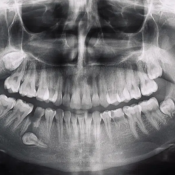 Odsłonięcie zębów zatrzymanych LUBLIN ALDENT