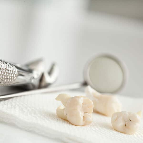 Usunięcie zębów mądrości