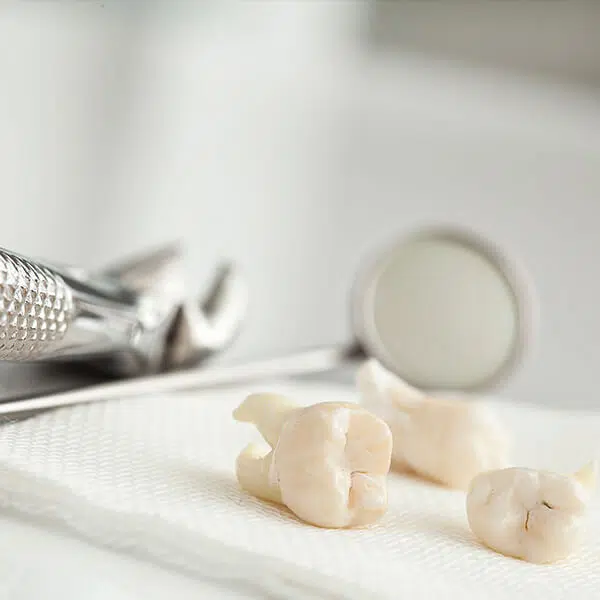 Usunięcie zębów mądrości (ósemek) LUBLIN ALDENT