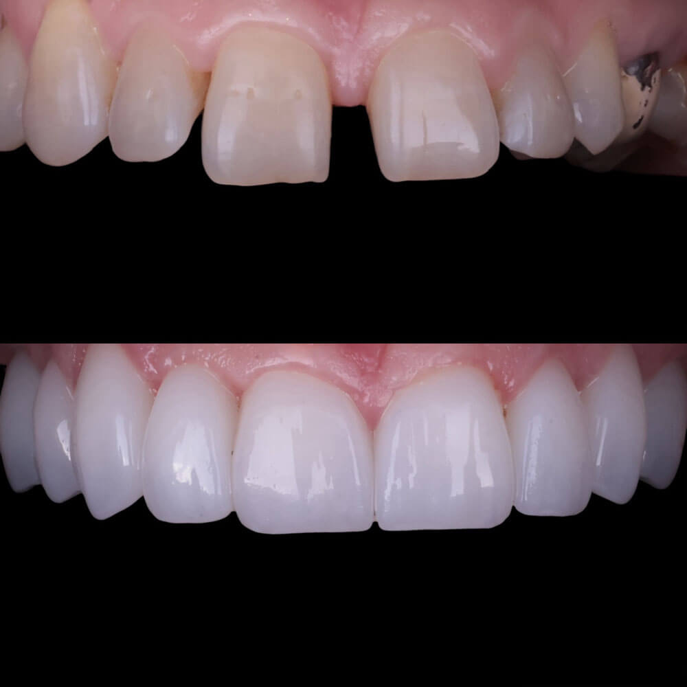 korony i licowki porcelanowe aldent lublin