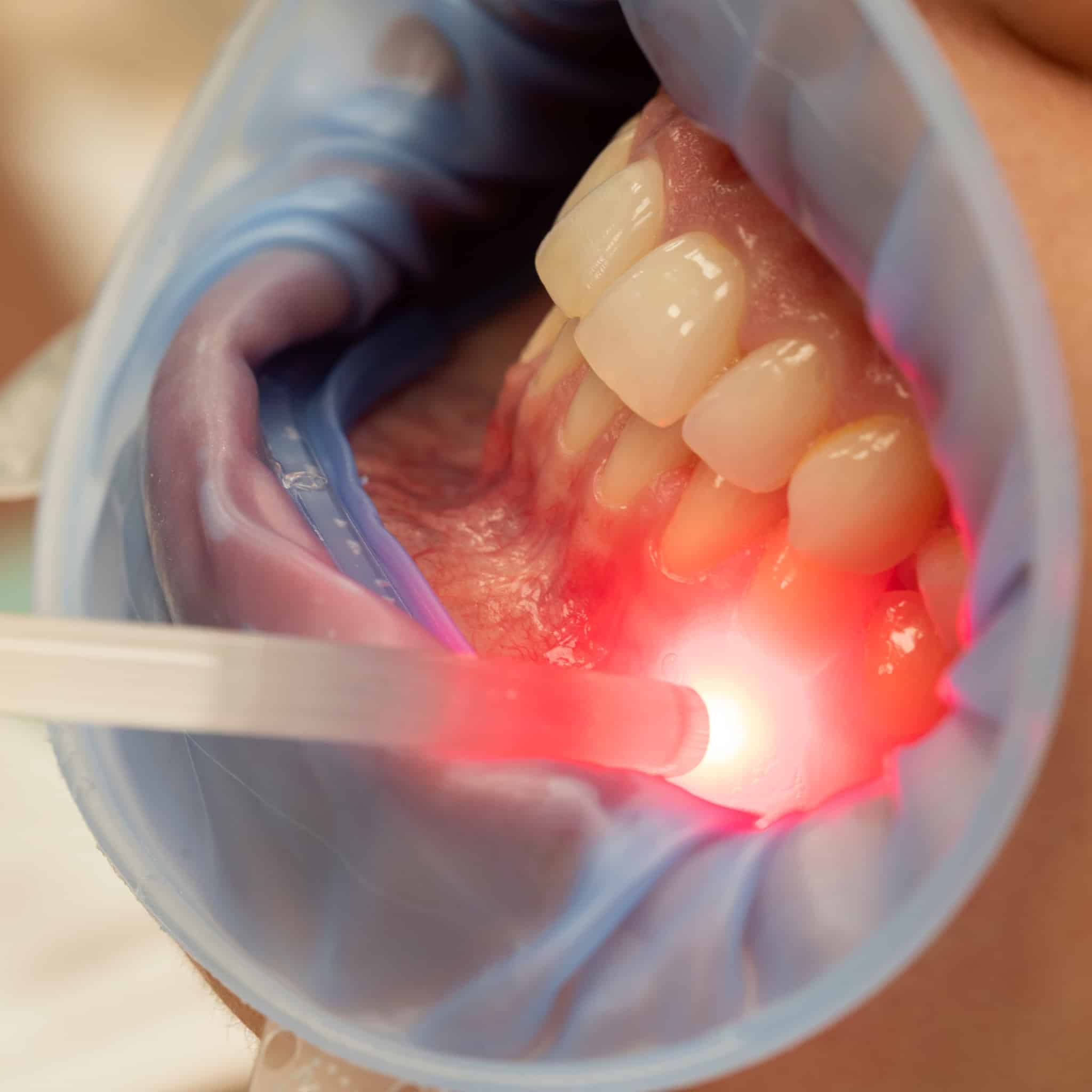 laserowa terapia biostymulacyjna