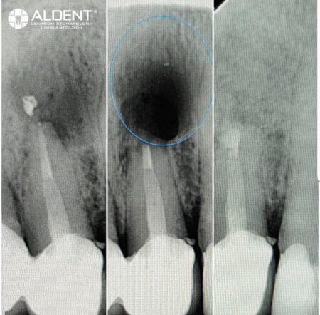 resekcja wierzchołka korzenia lublin aldent chirurgia stomatologiczna