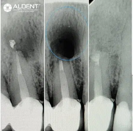 resekcja wierzchołka korzenia lublin aldent chirurgia stomatologiczna
