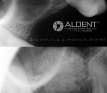 sinus lift podniesienie dna zatoki lublin aldent