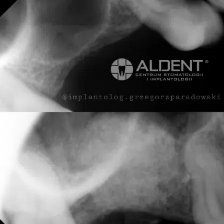 sinus lift podniesienie dna zatoki lublin aldent