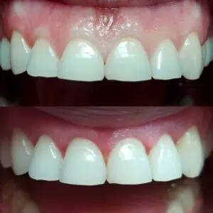 Odbudowa zębów przednich przez protetykę