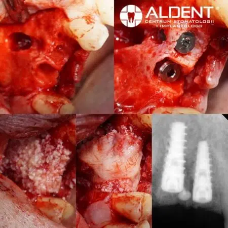 Sterowana regeneracja kości IMPLANTY