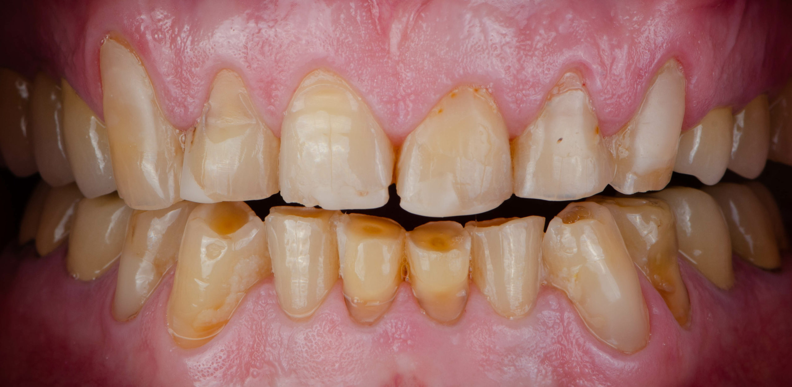 skutki nieleczonego bruksizmu starcie i zniszczenie zębów