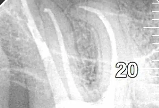 Leczenie kanałowe pod mikroskopem LUBLIN ALDENT