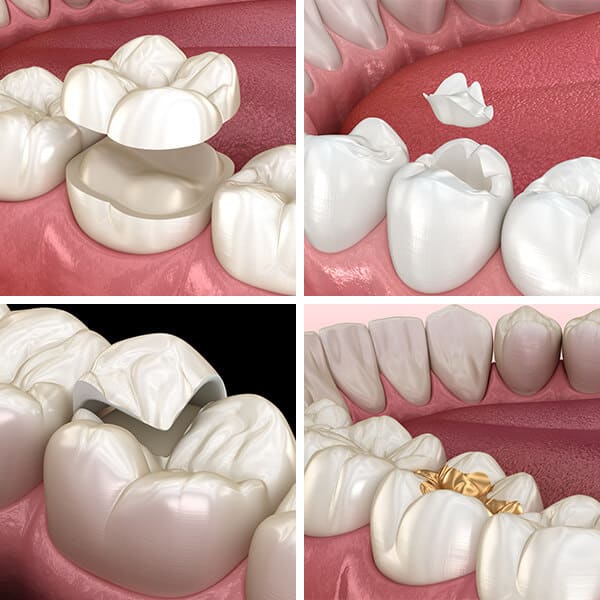 Nakładki porcelanowe