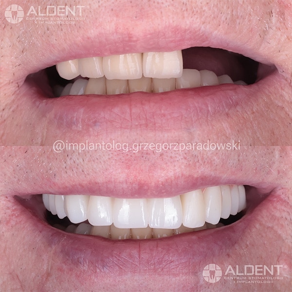 Kompleksowa odbudowa za pomocą implantów oraz mostów Aldent Lublin
