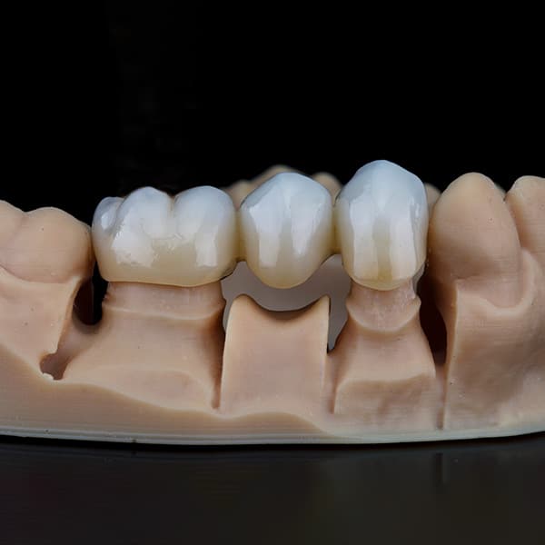 Skuteczna metoda odbudowy zniszczonych zębów