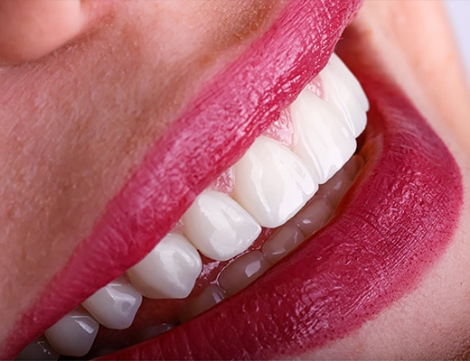 Zalety koron protetycznych