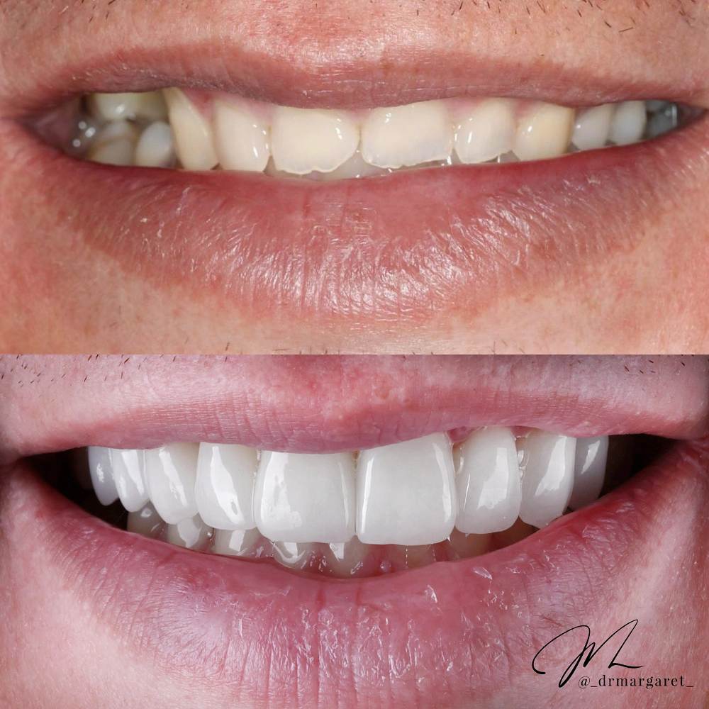 Korony pełnoceramiczne solowe