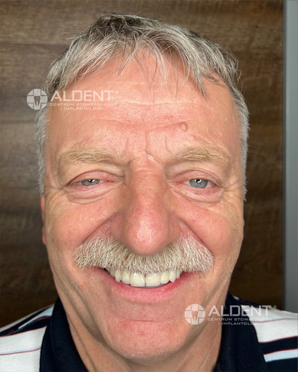 implanty cyfrowa protetyka efekt po aldent lublin