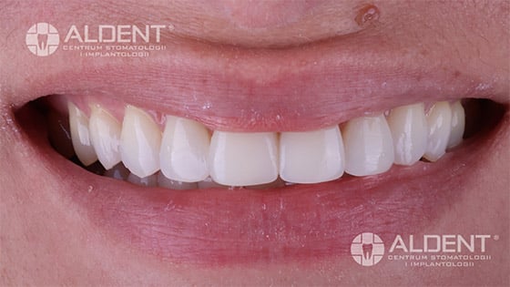 nowe zeby w 1 dzien aldent lublin