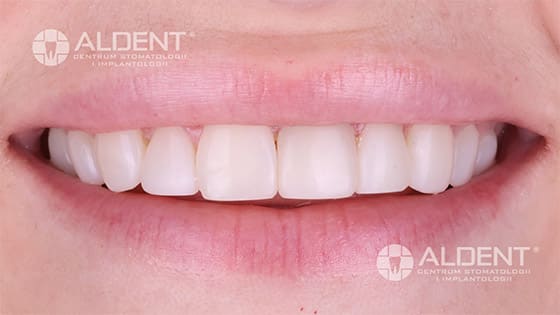po leczeniu invisalign oraz bondingu w dr paradowska