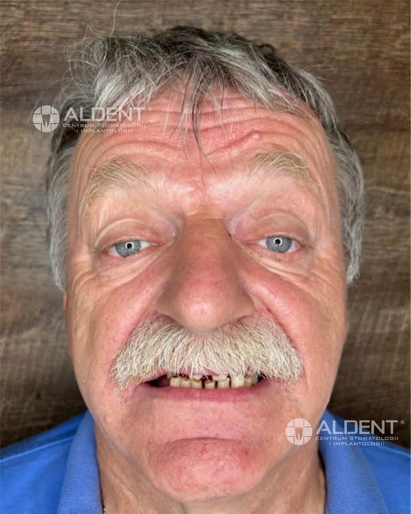 przed leczeniem implantoprotetycznym w aldent