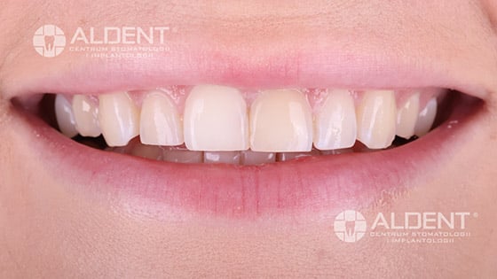 przed leczeniem invisalign oraz bondingiem