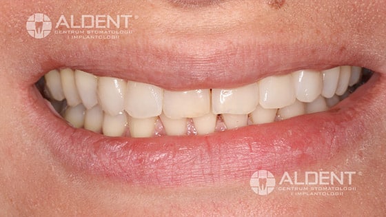 stan przed zamiana usmiechu w csk aldent w lublinie