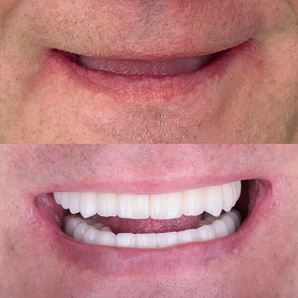 All on 4 zęby na stałe bez dziąseł na implantach w szczęce i żuchwie, trzecie zęby, implanty stomatologiczne w aldent