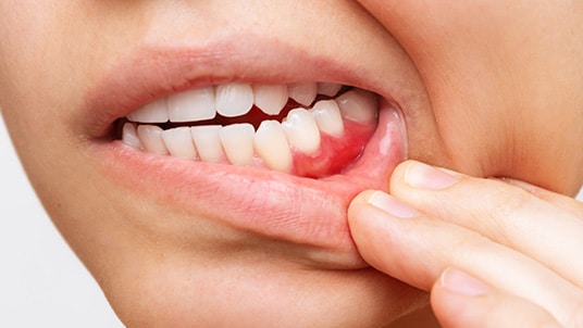 Czym jest paradontoza?