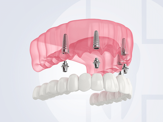 Dla kogo jest metoda All on 4®