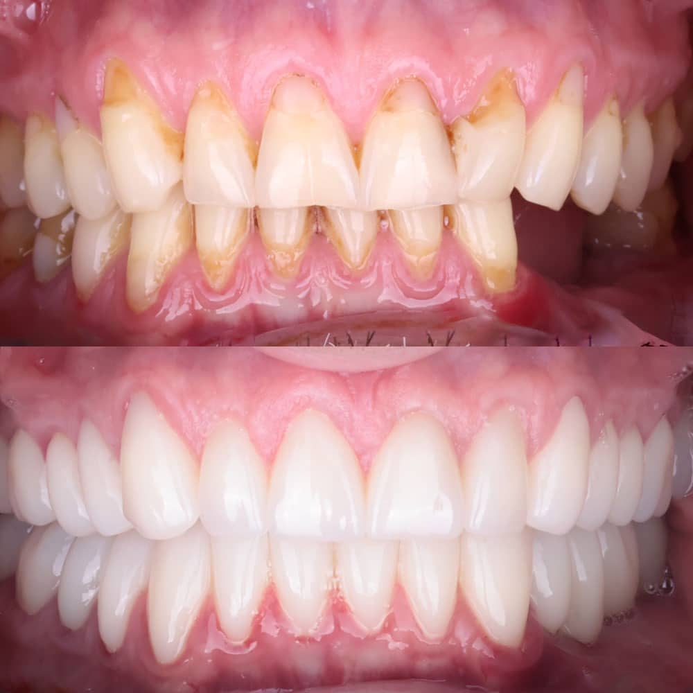 IMPLANTOPROTETYKA ODBUDOWA FUNKCJI ZUCIA