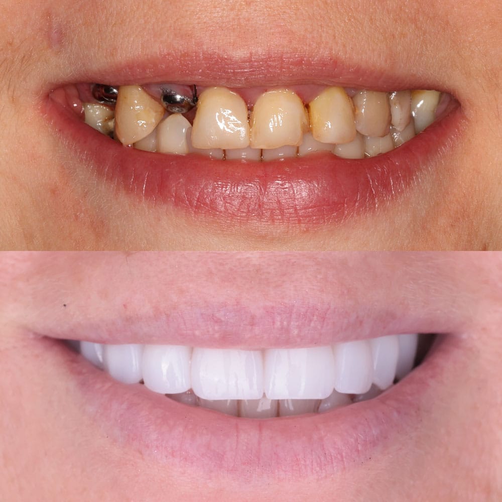 IMPLANTY ALDENT METAMORFOZA USMIECHU LUBLIN