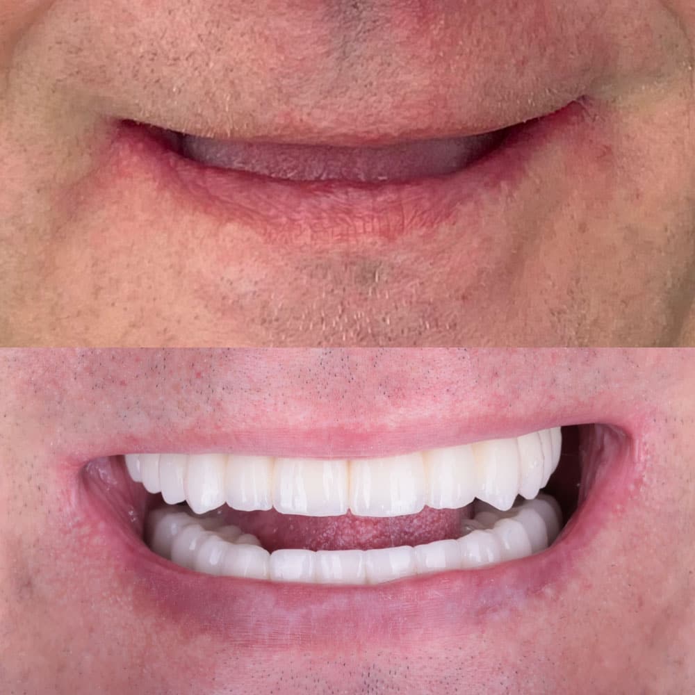 IMPLANTY ODBUDOWA PEŁNOŁUKOWA ZĘBY NA STAŁE IMPLANTY LUBLIN