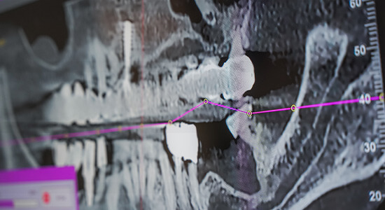 Tomografia 3D CBCT w celu sprawdzenia ilości kości przed implantami ALDENT LUBLIN