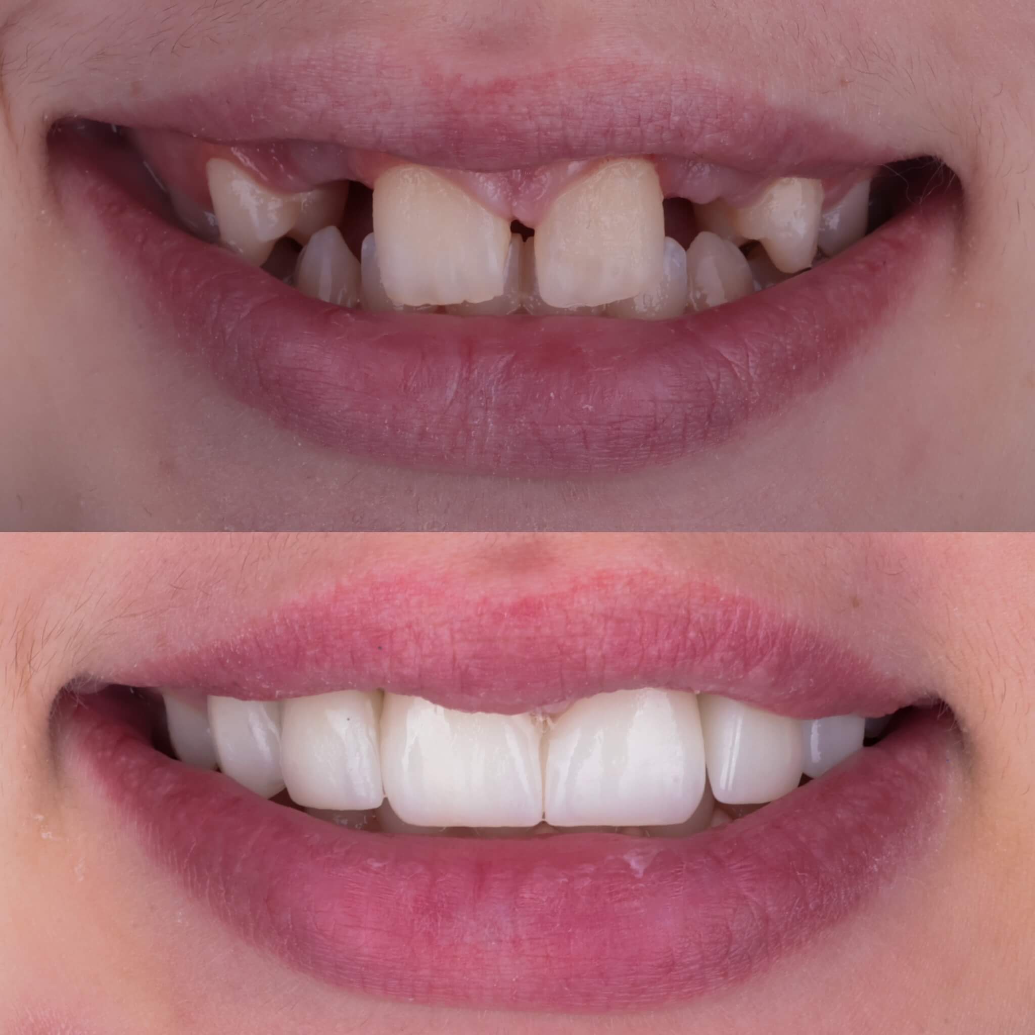 KORONY PEŁNOCERAMICZNE PROTETYK LUBLIN