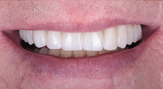 Most na implantach w jeden dzień CSK ALDENT LUBLIN