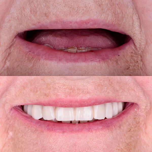 Nowe zęby przykręcane na 4 implantach Lublin Przy leczeniu bezzębia w CSK ALDENT