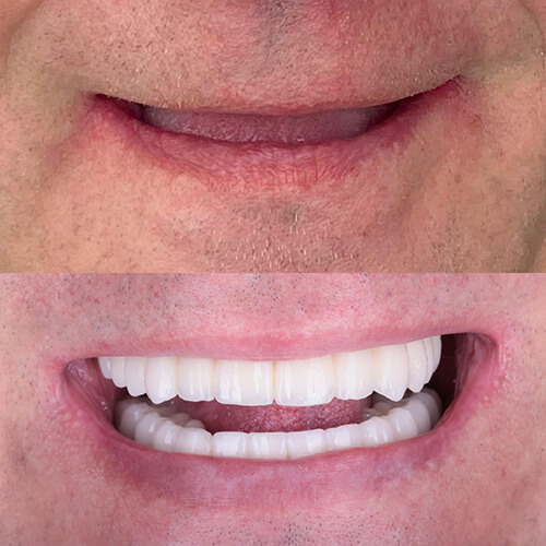 Odbudowa pełnych łuków zębowych na implantach Lublin ALDENT