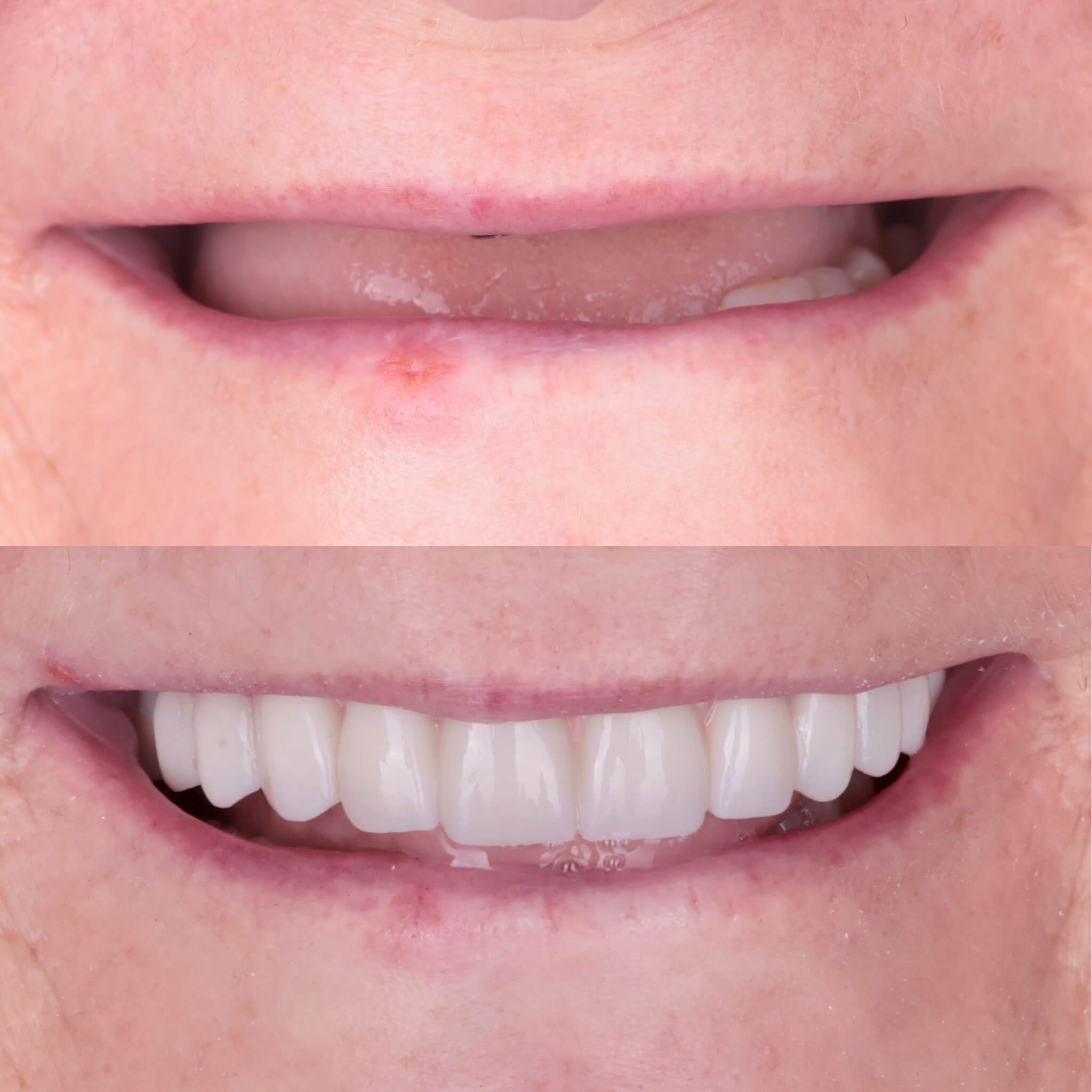 Proteza na implantach overdenture