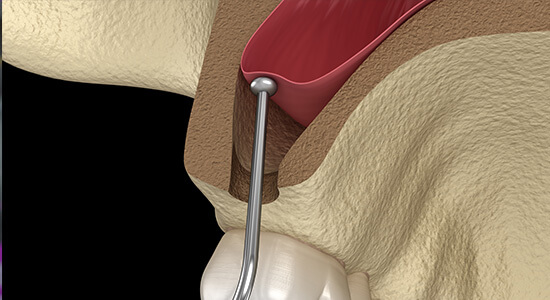 Sinus Lift Lublin - podniesienie zatoki szczękowej przed implantami zębów Lublin