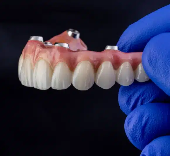 Implantoprotetyka-All-On-4-Lublin-Most-na-implantach