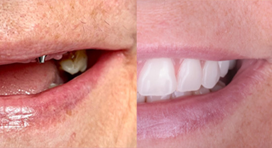 Praca tymczasowa po implantacji w ALDENT LUBLIN