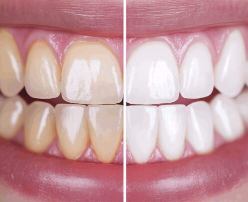 wybielanie zębów aldent lublin