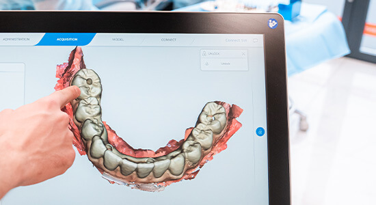 Gojenie implantu po wkręceniu do kości w ALDENT LUBLIN