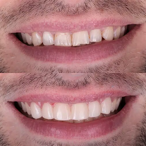 Nowy uśmiech w 1 dzień w LUBLIN ALDENT Przed i Po