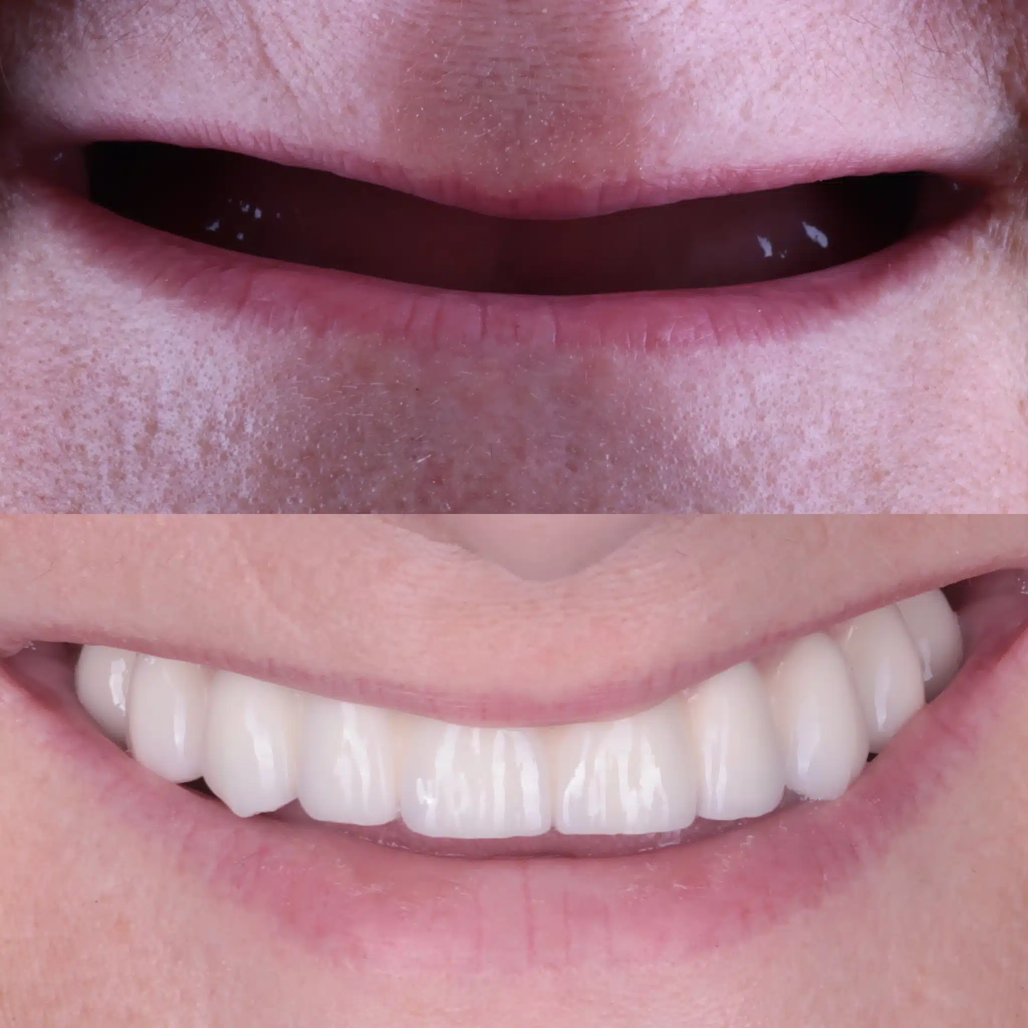 Nowy uśmiech w 1 dzień ALL ON 6